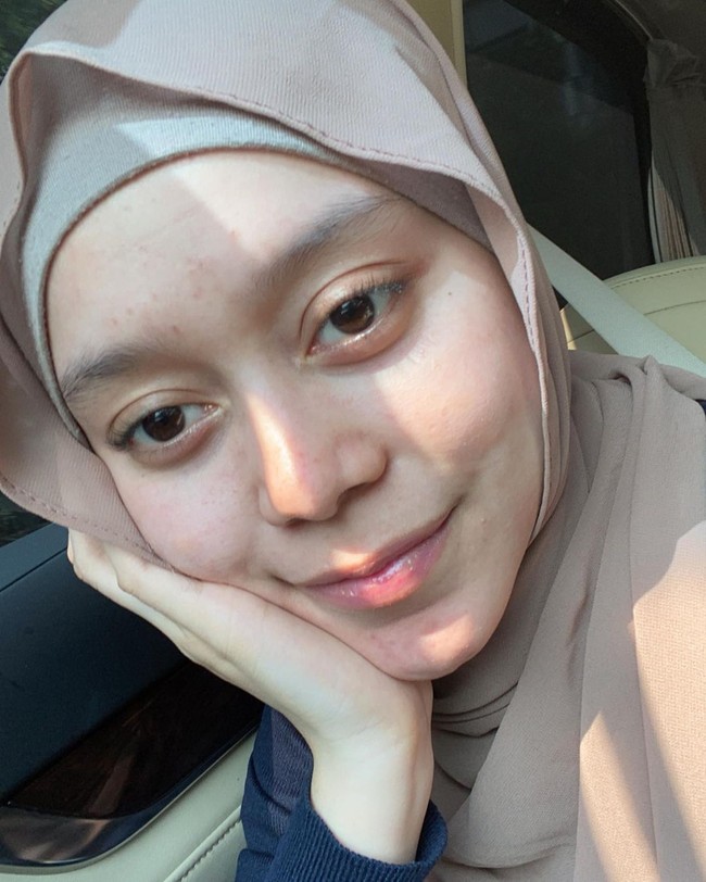 Wajah Lesti sebelumnya menjadi sorotan ketika ia diketahui menjalani sejumlah perawatan di klinik perawatan. Dalam postingan yang diunggah sebuah klinik kecantikan, pengantin baru itu dikatakan melakukan Botox, tanam benang, infus, laser, hingga filler. Foto: Instagram