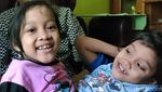 Potret Dewi dan Putri, Bocah Kembar Siam Dempet Perut di Garut