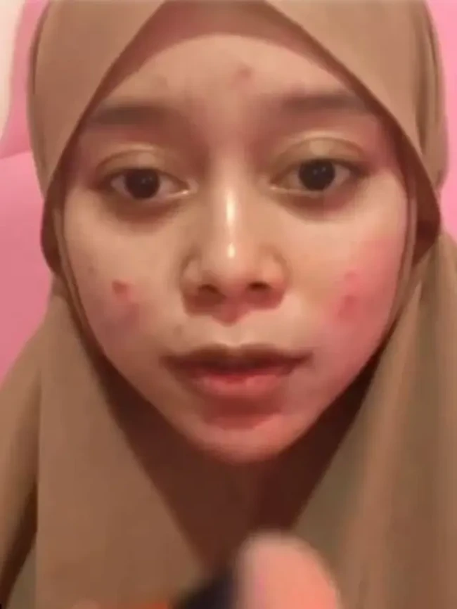 Inilah penampakan Lesti Kejora beberapa tahun lalu. Belum mengenal banyak perawatan, wajah istri Rizky Billar ini berjerawat. Foto: Instagram