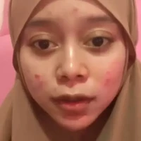 Inilah penampakan Lesti Kejora beberapa tahun lalu. Belum mengenal banyak perawatan, wajah istri Rizky Billar ini berjerawat. Foto: Instagram