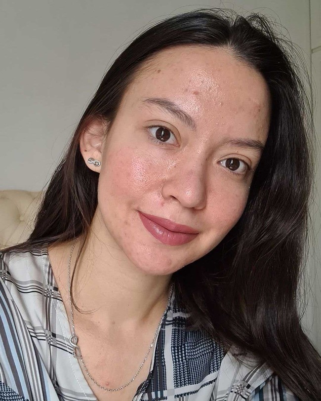 Puteri Indonesia Pariwisata 2017 Karina Nadila juga pernah menampilkan wajahnya dengan jerawat. Dia mengaku sejak masa puber menjadi pejuang jerawat. Foto: Instagram