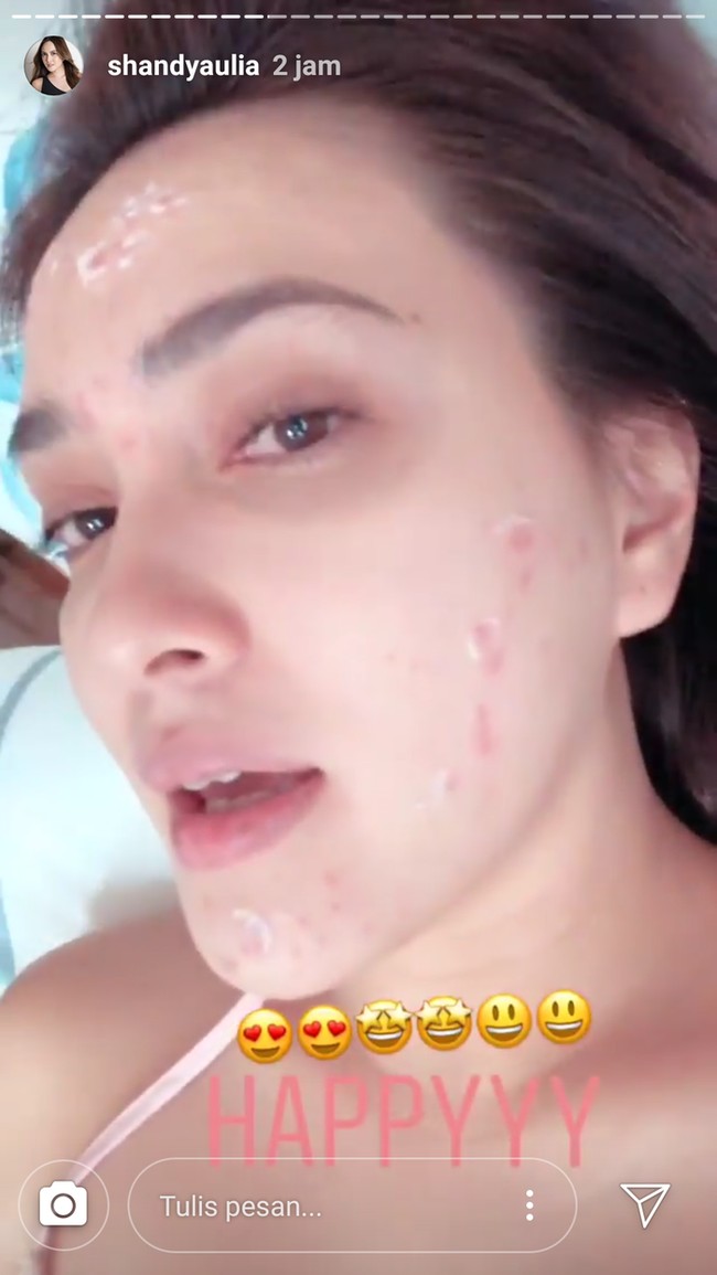 Dikenal berkulit cerah dan tampak selalu flawless, ternyata tidak selamanya kondisi kulit Shandy Aulia selalu baik. Di 2018, Shandy menunjukkan wajah berjerawatnya di Instagram Story-nya. Foto: Instagram