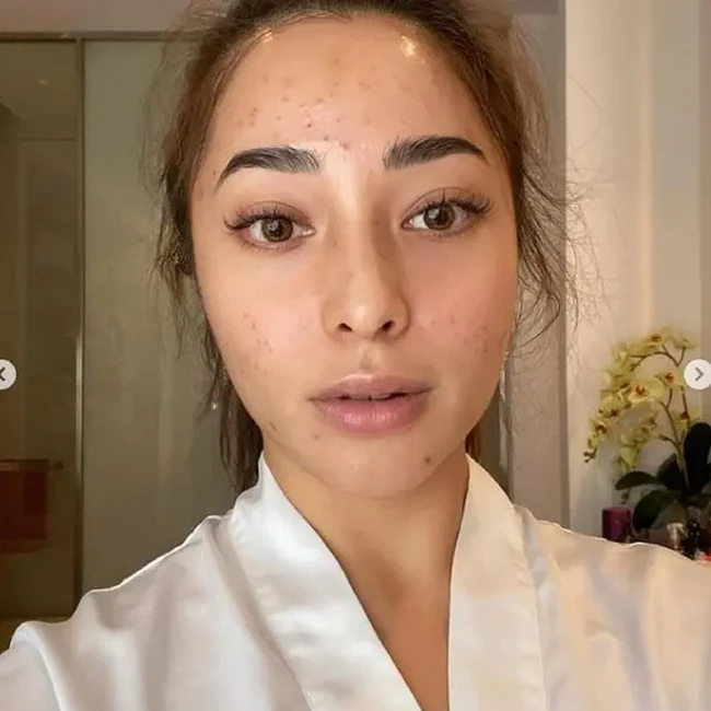 Nikita Willy belum lama ini menunjukkan wajahnya yang berjerawat. Dalam unggahannya di Instagramnya, Niki mengaku wajahnya jadi banyak jerawat sejak bulan Januari sampai Maret. karena aku belum pernah mengalami hal ini sebelumnya... nangis setiap malam kalau liat muka ku di kaca dan malu banget karena punya skincare line kok jerawatan!? ungkap Nikita. Namun akhirnya dia bisa mengatasi masalah kulitnya itu. Foto: Instagram
