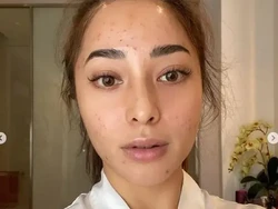 7 Deretan Artis Indonesia Pejuang Jerawat, Nissa Sabyan Wajahnya Diperban