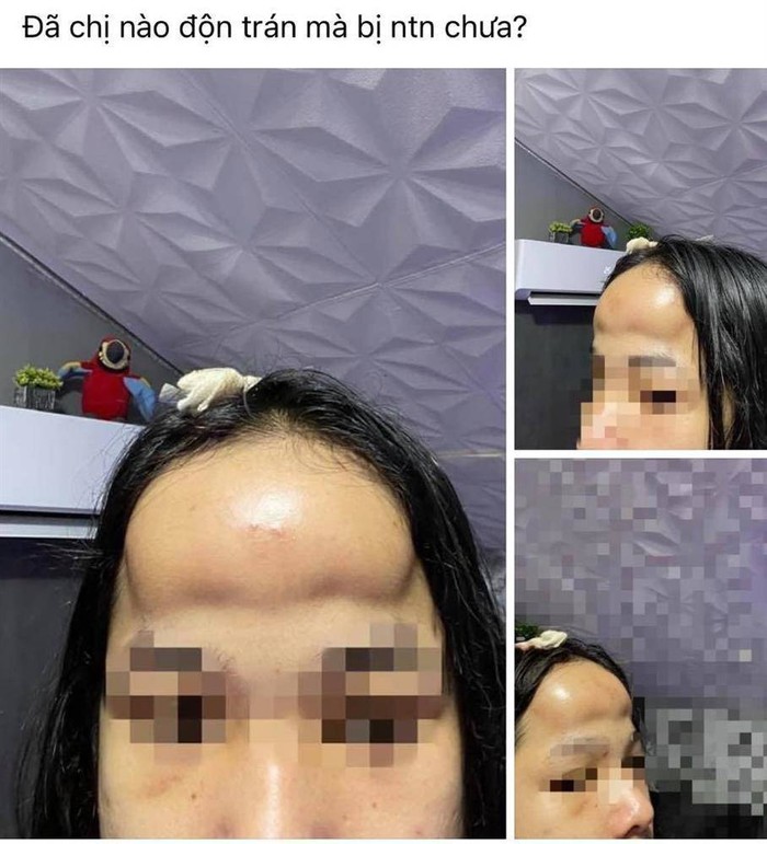 Prosedur implan dahi gagal