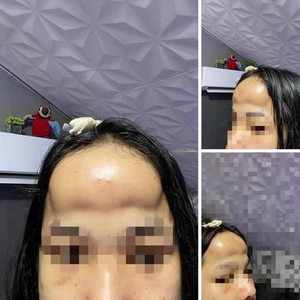 Gagal Cantik, Wanita Ini Mau Implan Dahi Endingnya Malah bak Disengat Lebah Gagal Cantik, Wanita Ini Mau Implan Dahi Endingnya Malah bak Disengat Lebah