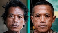 Beginilah potret Nongki, (kiri) saat diserahkan keluarga dan baru diterima pihak yayasan. (kanan) Tampang Nongki sesudah dibersihkan dan diterima berbaur bersama dengan pasien lainnya. 