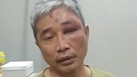 Foto Muhammad Kace setelah dianiaya Irjen Napoleon Bonaparte di Rutan Bareskrim Polri terungkap. Wajah Muhammad Kace tampak lebam. Muhammad Kace merupakan tersangka kasus dugaan penistaan agama. Di Rutan Bareskrim Polri, Muhammad Kace dianiaya dengan cara dipukul hingga dilumuri kotoran manusia oleh Irjen Napoleon Bonaparte yang terjerat kasus korupsi. (Foto: Foto wajah lebam M Kace hingga Azis Syamsuddin yang diborgol di KPK (detikcom)