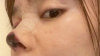 Lama-kelamaan ia mulai panik dan ternyata bagian tersebut telah membusuk dan membuat hidungnya tak bisa kembali normal lagi hingga butuh proses penyembuhan selama 2 tahun. Dok. Weibo