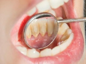 12 Cara Menghilangkan Karang Gigi Secara Alami Sendiri di Rumah