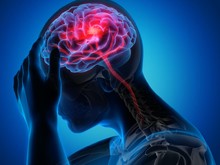 Makin Banyak Usia Muda Kena Stroke, Ini Gejala Awal yang Mereka Keluhkan