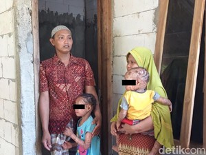 Idap Iktiosis Lameral, Kakak-Adik di Boyolali Kulitnya Bersisik Pecah-pecah