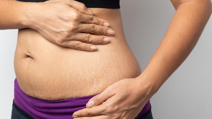 5 Penyebab Stretch Mark di Paha dan Cara Menyamarkannya