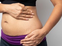 5 Penyebab Stretch Mark di Paha dan Cara Menyamarkannya