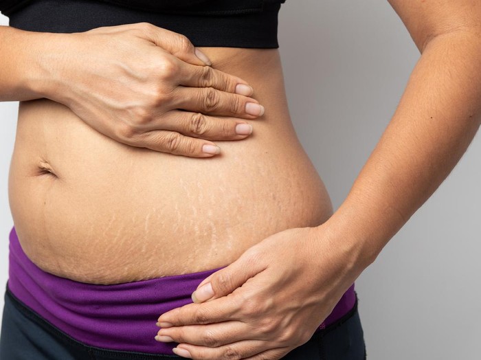 Stretch mark