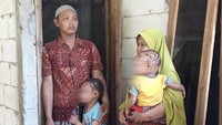 Putri Raya (7) dan Hanafi (2), anak kedua dan ketiga pasangan Sutarmo (36) dengan Puji Handayani (36) mengidap kondisi ini sejak lahir. Diagnosa dokter kedua anaknya tersebut menderita iktiosis lameral.