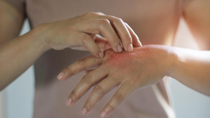 Healthcare and medical concept. Female scratching the itch on her hand, cause of itching from skin diseases, dry skin, allergy, chemical, allergic to detergent or dishwashing liquid and dermatitis, insect bites, burned, drug. Health problem.