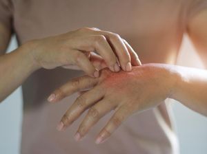 7 Obat Biduran Alami yang Mudah Ditemui, dari Lidah Buaya hingga Kunyit