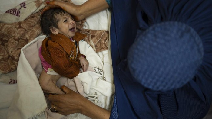 Gizi Buruk Membayangi Jutaan Anak-anak di Afghanistan Ancaman gizi buruk kian nyata di Afghanistan. Kondisi perekonomian yang belum stabil membuat orang tua di negara itu mati-matian penuhi kebutuhan anak mereka.