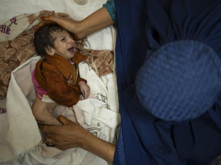 Gizi Buruk Bayangi Jutaan Anak-anak di Afghanistan