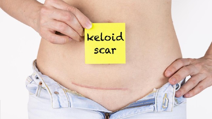Muncul Keloid Usai Operasi Caesar? Ini 4 Cara Menyamarkannya