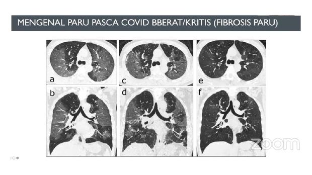 Mengenal paru pasca COVID berat.