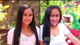 Idap Kondisi Langka, Gadis 16 Tahun Ini Terlihat Seperti Nenek