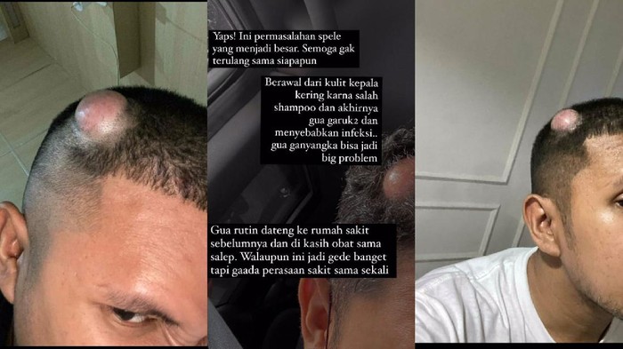 VIral tiktok garuk-garuk kepala berujung tumor Viral di TikTok curhat pria idap tumor gara-gara keseringan garuk kepala.