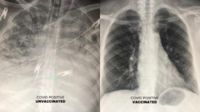 Screenshot viral Penampakan Paru Pasien COVID-19 yang Sudah Vaksin Vs Belum, Ini Hasilnya