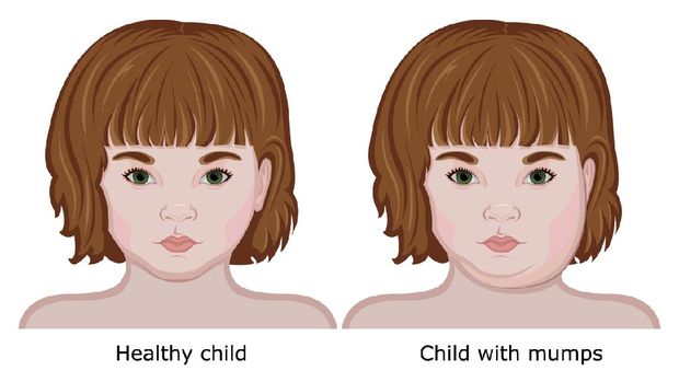 Ilustrasi gondongan pada anak