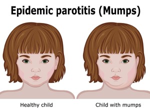 Pengertian Penyakit Parotitis: Penularan, Pencegahan hingga Apakah Bisa Sembuh?