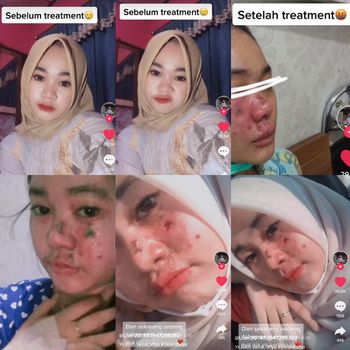 Kisah viral remaja yang wajahnya rusak usai treatment facial di salah satu klinik.