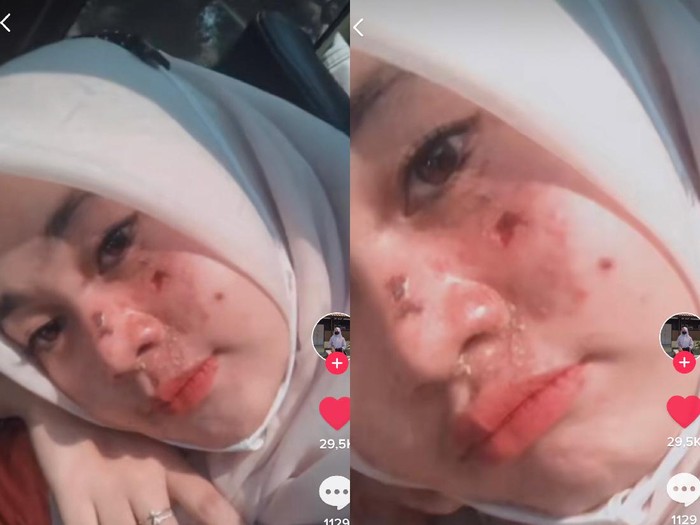 Kisah viral remaja yang wajahnya rusak usai treatment facial di salah satu klinik. Kisah viral remaja yang wajahnya rusak usai treatment facial di salah satu klinik.