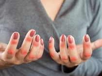 Penjelasan Dokter soal Peluang Sembuh Penderita Autoimun