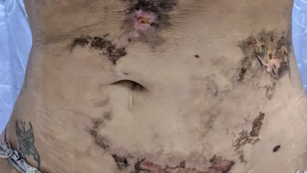 Kondisi tubuh wanita pasca operasi plastik gagal total.