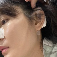 Aku mau share yaaa..... ke kalian banyak banget yang dm ke aku nanya, ka angel OP di mana.... dll dll kalo aku saranin... aku jujur nyesel mutusin buat OP hidung karena kendala hidung miring, sampe kejadian jadi kemarin tuh implan aku jebol.... ampe mau tembus ke kulit jadi posisinya uda nonggol gitu.... tulis Angela Lee melalui akun Instagramnya @angelalee87. Foto: Dok. Instagram @angelalee87.