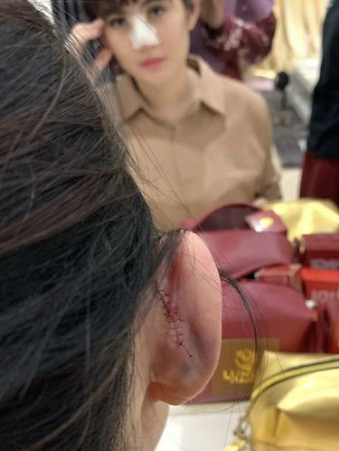 Angela Lee menyesal usai menjalani operasi hidung.