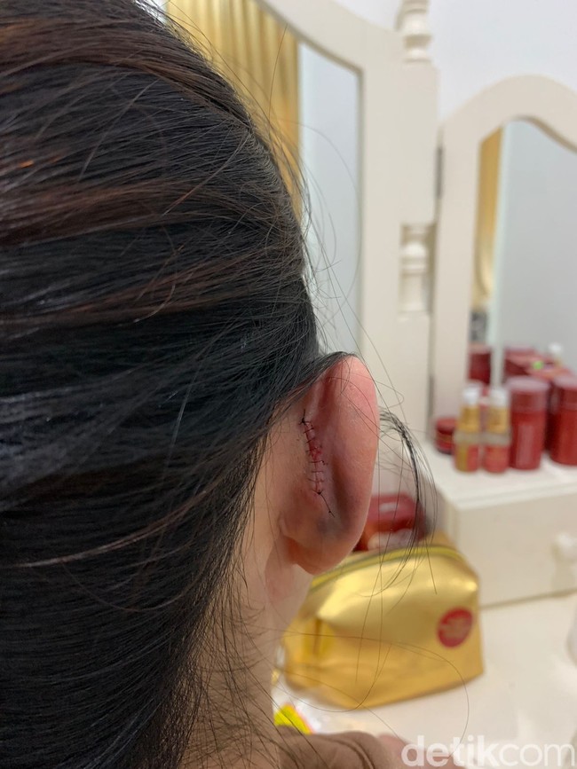 Dalam unggahannya tersebut, Angela Lee memperlihatkan hidungnya yang dioperasi lagi setelah implannya jebol. Tampak area telinga Angela ditutupi kain perban. Dia juga memperlihatkan bekas jahitan di tulang rawan telinganya.Foto: Dok. Instagram @angelalee87.