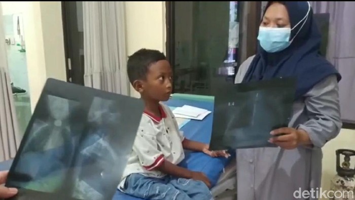 Fatan, bocah yang menelan uang logam d Brebes