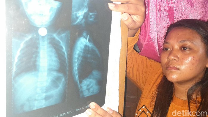 Penampakan uang logam di tenggorolan bocah Brebes