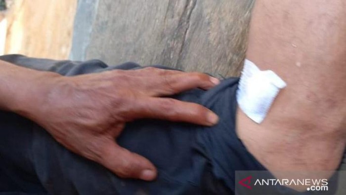 Penampakan kaki Ketua DPRD Bangka luka akibat gigitan buaya (Antara)