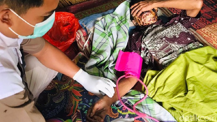 Warga Pandeglang wajahnya melepuh terkena air panas.