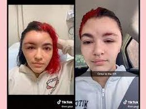 Viral Wanita yang Iritasi Cat Rambut, Wajahnya Jadi Bengkak Sebelah