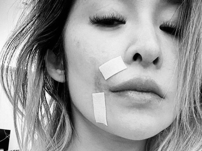 Elva Hsiao menunjukkan luka akibat digigit oleh anjing miliknya.