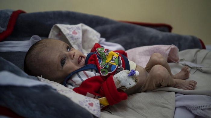 Gizi buruk dan kelaparan masih membayangi anak-anak di Afghanistan. Kasus anak-anak yang alami gizi buruk pun kian bertambah di Afghanistan imbas krisis ekonomi