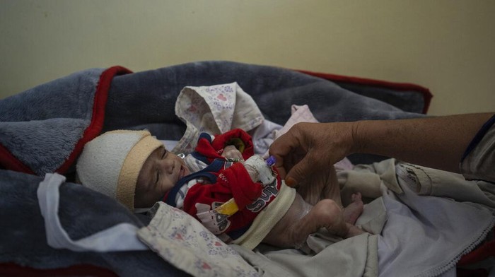 Gizi buruk dan kelaparan masih membayangi anak-anak di Afghanistan. Kasus anak-anak yang alami gizi buruk pun kian bertambah di Afghanistan imbas krisis ekonomi
