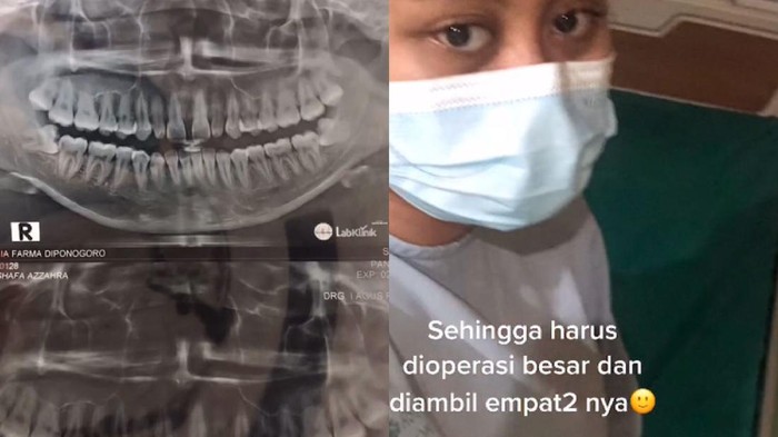 Viral gigi bungsi impaksi viral gigi bungsi impaksi