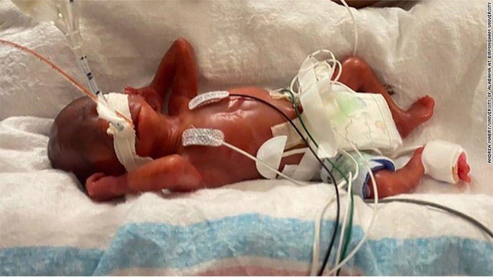 Bayi yang lahir paling prematur sedunia.