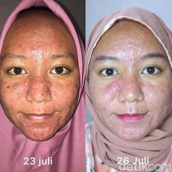 Kisah Rika Widiawati yang menjadi acne fighter.