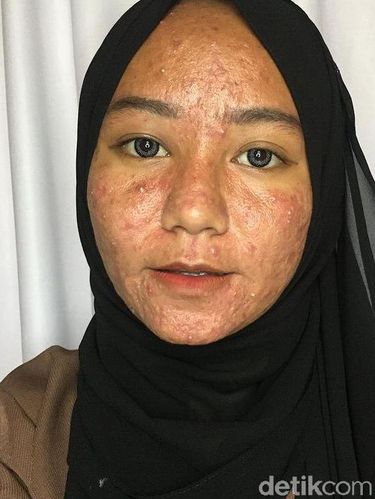Kisah Rika Widiawati yang menjadi acne fighter.